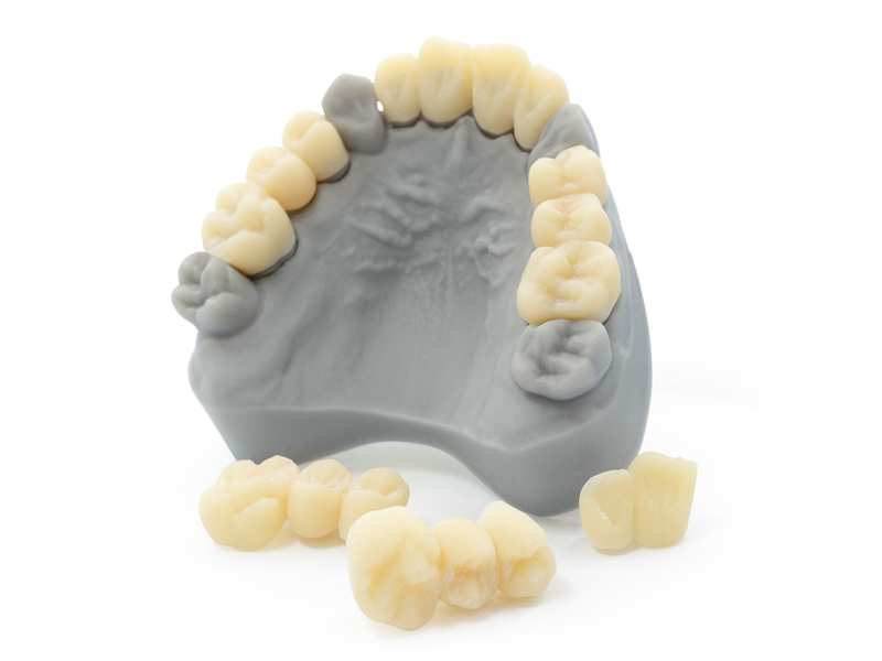 Mit Dental Sand PRO gedruckte Zahnkronen und -brücken